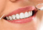 Dental composites