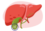 Gallstone